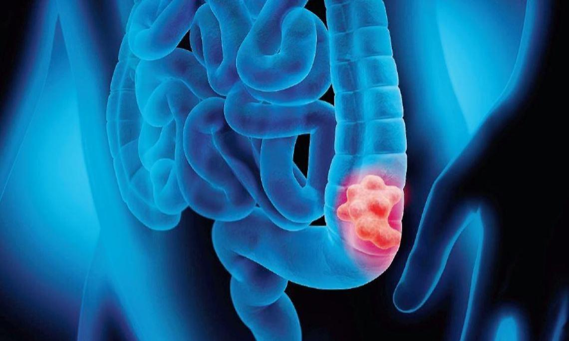 Tumore al colon, la novità dal Gruppo Ini: un esame che può salvare la vita