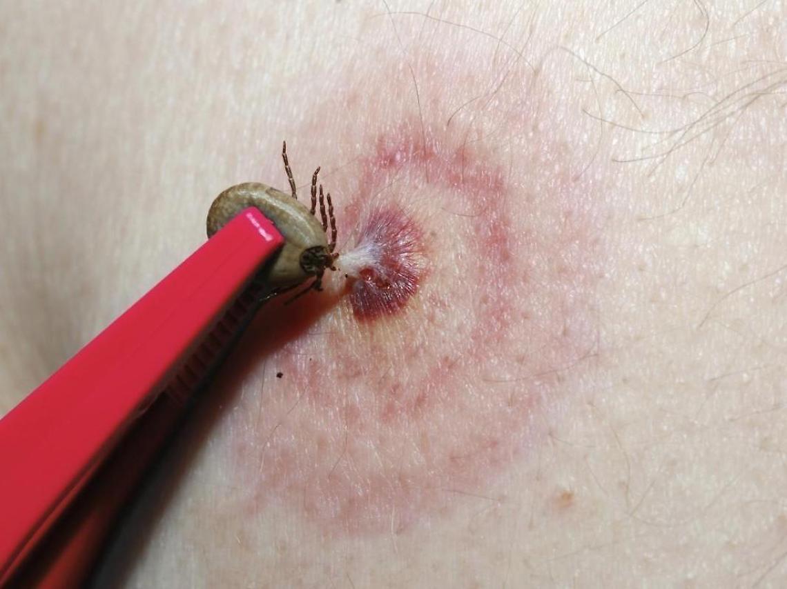 Giovane morso da una zecca: la corsa in ospedale con febbre e brividi