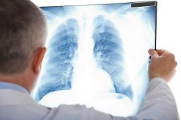 Alatri, lotta contro la fibrosi cistica: giornata di sensibilizzazione