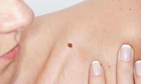Le "sentinelle speciali" della pelle: i nei. Come riconoscere quelli pericolosi